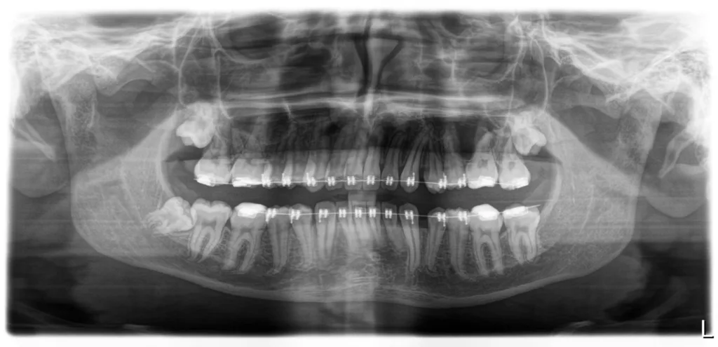 Picture of an xray taken at prism dental